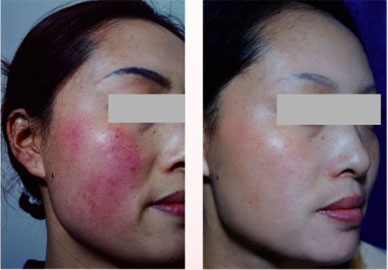 ������tѪ�z�����DƬЧ��