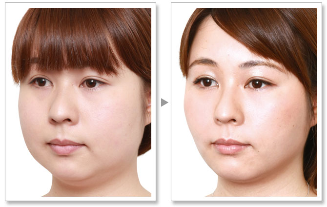 瘦40斤变化脸对比照图片