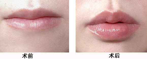 注射玻尿酸丰唇前后对比图