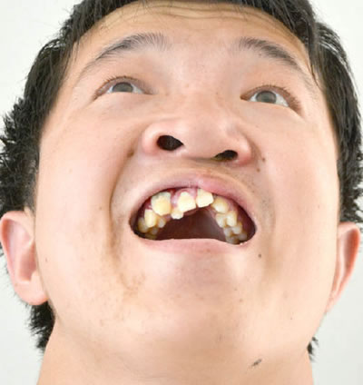 唇腭裂患者李明