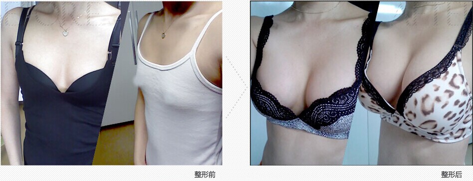 原辰隆胸手术对比图
