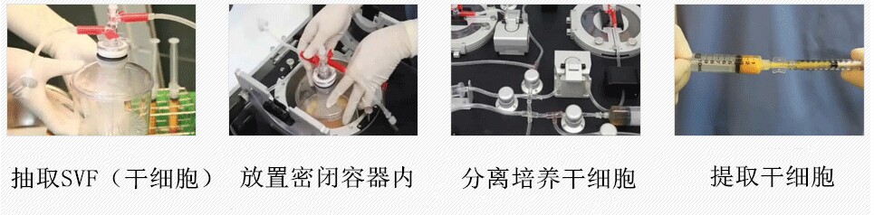 脂肪移植示意图