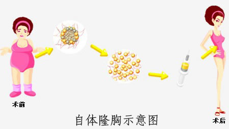 韩国BK整形医院自体脂肪丰胸