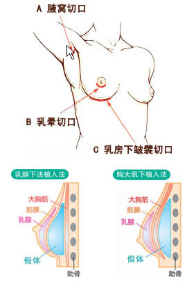 假体隆胸切口