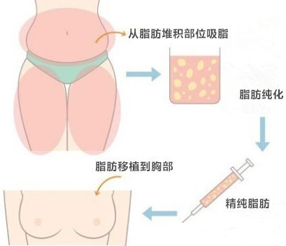 自体脂肪丰胸