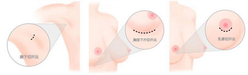 贵阳利美康假体丰胸切口