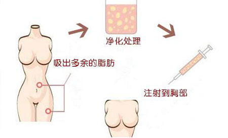 利美康整形自体脂肪丰胸
