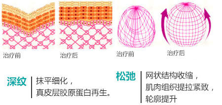 热玛吉除皱效果图
