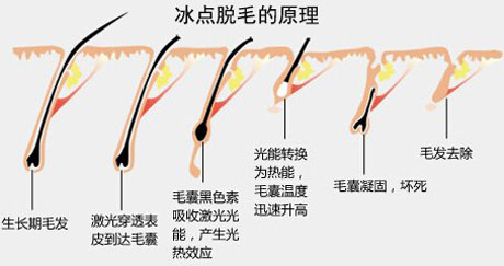 冰点脱唇毛要几次才有效