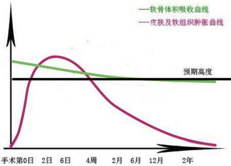 自体软骨隆鼻