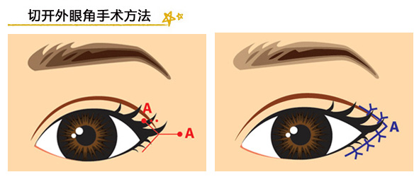 开外眼角