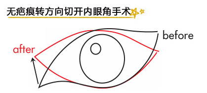 开内眼角