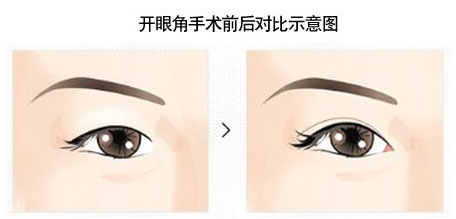 开眼角手术