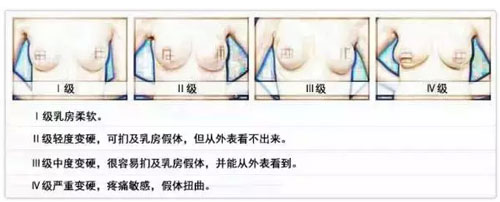 假体隆胸包膜挛缩分级