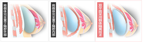 双平面隆胸