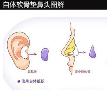 自体软骨垫鼻尖