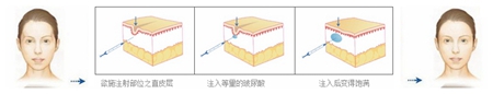 玻尿酸丰太阳穴