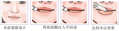 玻尿酸丰唇