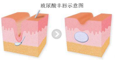 玻尿酸丰唇