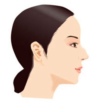 鹰钩鼻矫正