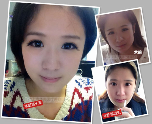 李志海改脸型