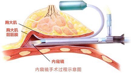 北京叶子整形娜绮丽假体隆胸
