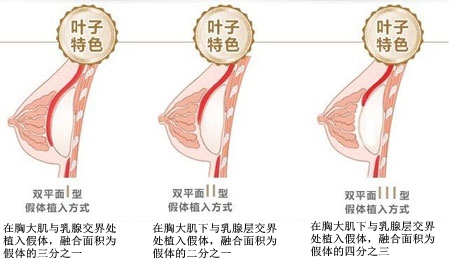 北京叶子整形娜绮丽假体隆胸