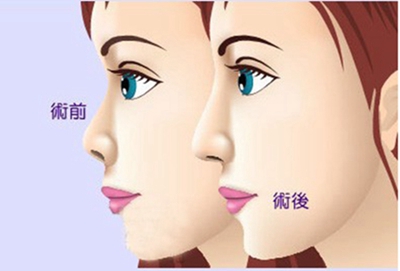 深圳弘美整形黄印资隆鼻