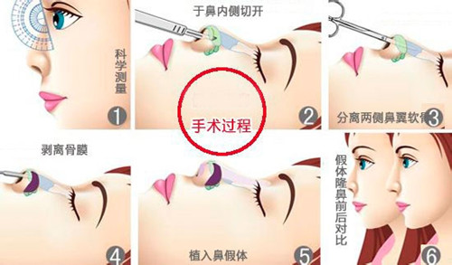 假体隆鼻