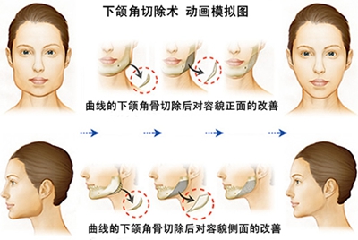 重庆华美下颌角整形