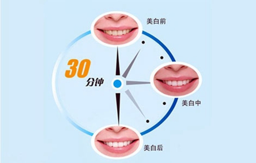 微整形牙齿冷光美白