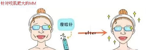 杭州时光整形瘦脸