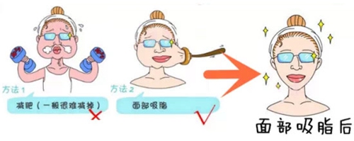杭州时光整形面部吸脂