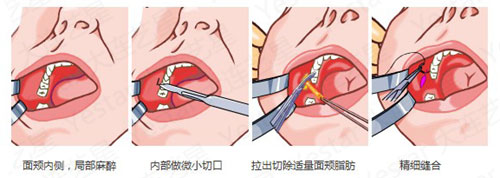 杭州时光整形祛颊脂垫