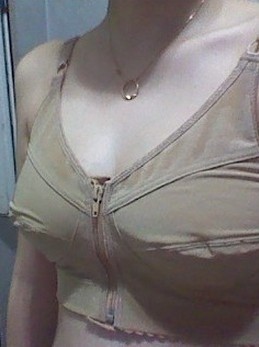 巨乳缩小整形