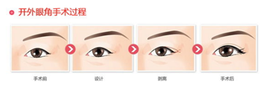开外眼角