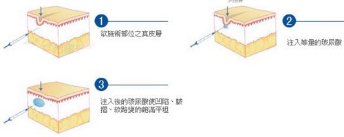 玻尿酸注射填充