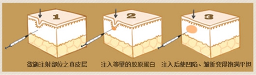 胶原蛋白注射填充