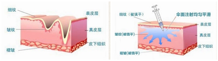 济南海峡整形肌肤除皱术