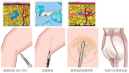 小腿吸脂