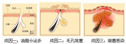 长痘痘原因