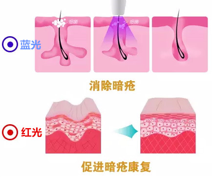 红蓝光祛痘