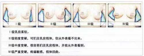 隆胸假体变硬