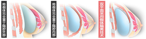 双平面假体隆胸