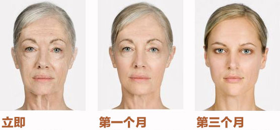 电波拉皮除皱
