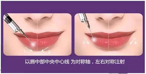 玻尿酸注射丰唇