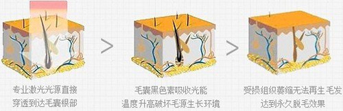 激光脱毛
