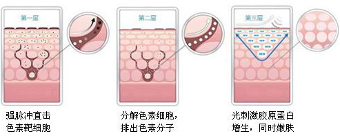 激光美白