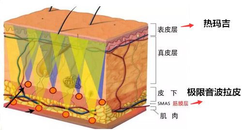 音波拉皮和热玛吉作用层次不同