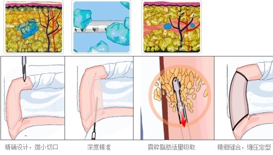 胳膊吸脂